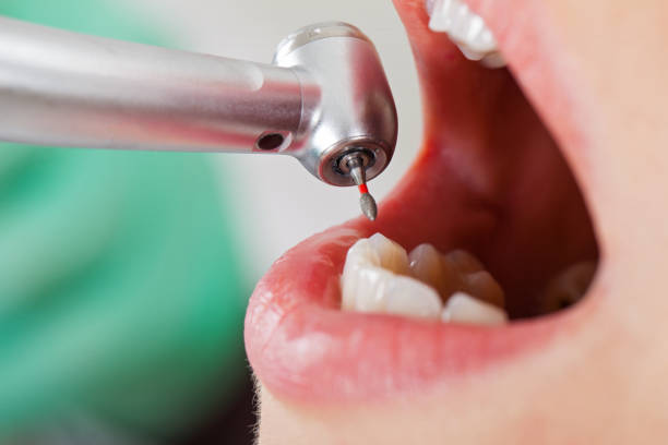 Best Chipped Tooth Repair Near Me  in Bellaire, OH